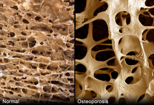 porównanie kości osteoporoza