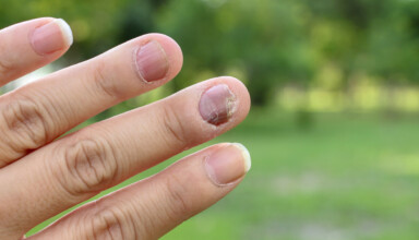 Onycholiza paznokcia – co to właściwie jest
